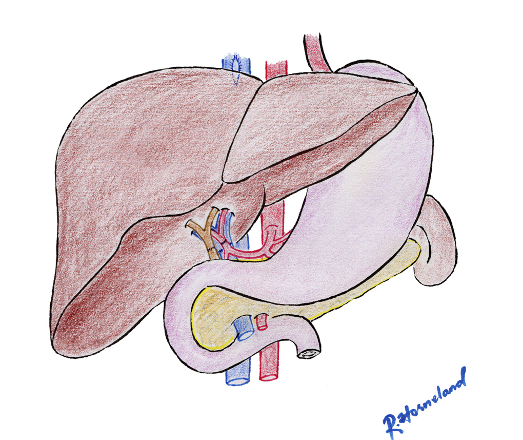 Figur 4. Viser status etter innsying av levertransplantat med standard teknikk. Levervenene er sydd a.m Piggy-back, porta- og arterieanastomosene som ende til ende anastomoser og galleveisanastomsosen som duct til duct.