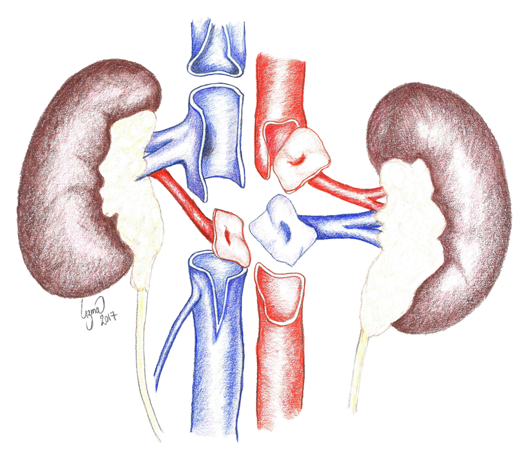 Figur 3. Utklipping av nyrer med aortapatch og cavapatch.
