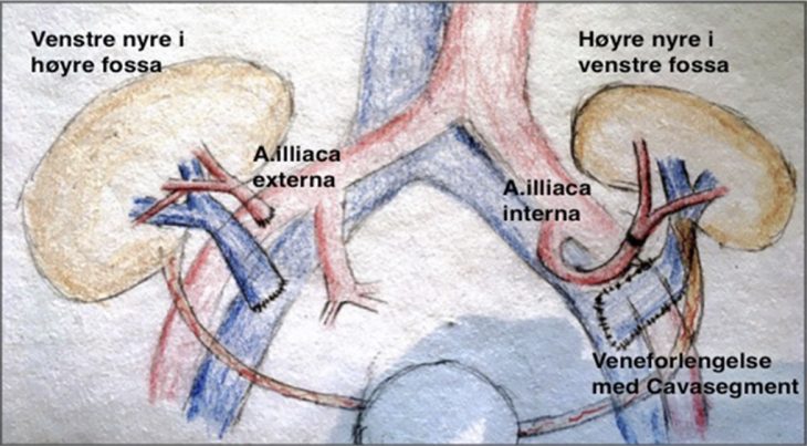 Bilde 2. Typisk plassering av nyregraft i fossa illiaca: Venstre nyre: arterieanastomose mot A. illiaca externa. Høyre nyre med cavaplastikk som forlengelse av venen, arterieanastomose mot A. illiaca interna