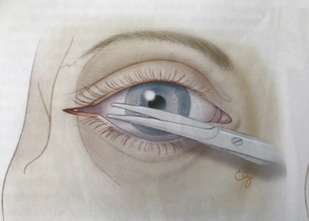 Figur 3: Lateral cantotomi. Øyet beskyttes med uskarpt instrument. En skarp saks føres over laterale cantus helt til man støter mot beinkanten. En klipper så gjennom huden og underliggende cantalligament. 
