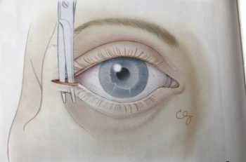 Figur 4: Ytterligere reduksjon av intraorbitalt trykk kan oppnås med påfølgende inferior cantolyse ved å rette saksen nedover og klippe nedre halvdel av ligamentet i nedre øyelokk.