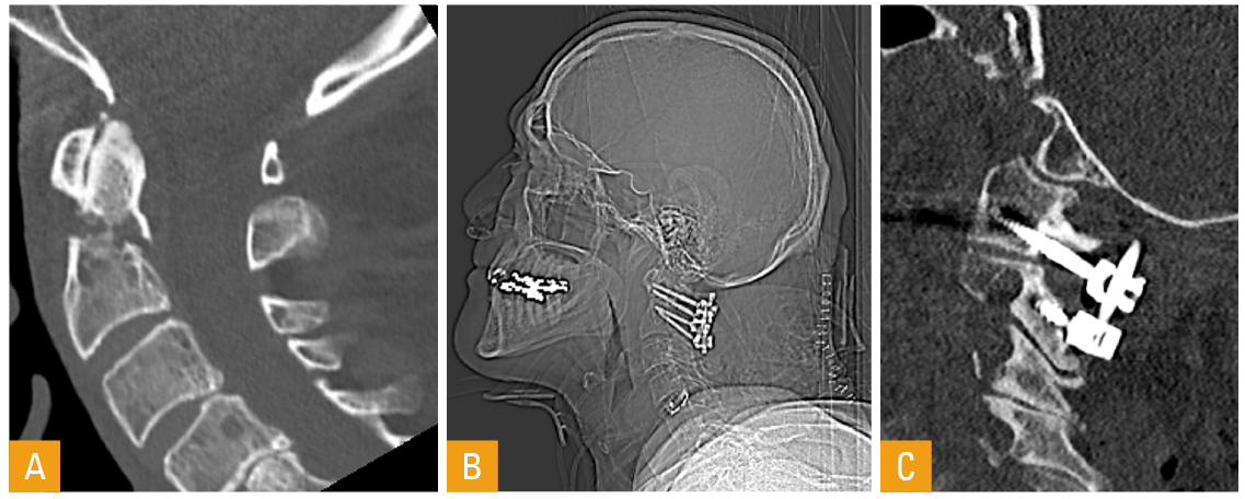 Figur 3. Densfraktur Type II med lettgradig posterior dislokasjon og diastase i frakturspalte, sagittalt CT snitt (A). Oversikt røntgen og CT sagittalt etter bakre skrue/stag ­fiksasjon C1 til C2 (B og C).