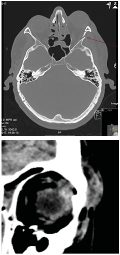 Figur 2: Venstresidig orbitafraktur. Pasienten har nedsatt syn og eksoftalmus. Et hematom er lokalisert mellom periorbita og frakturen og det en grei fremre tilgang via øyebrynet.