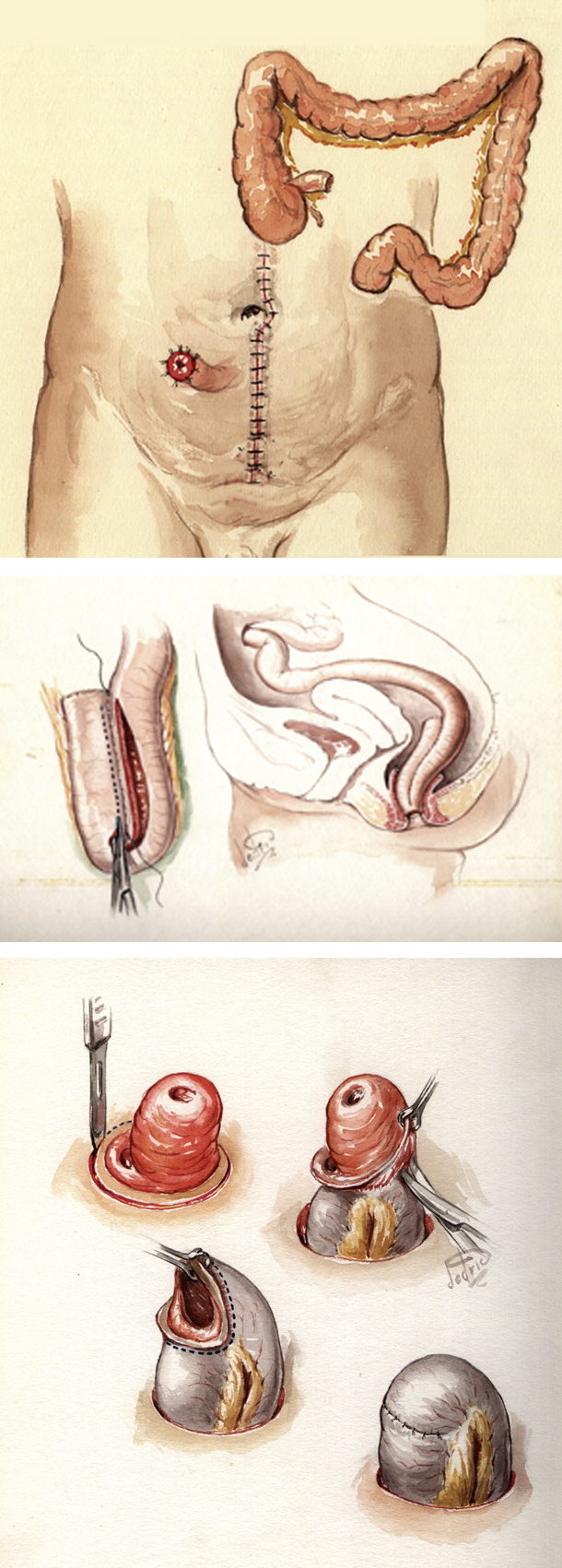 Figur 1: Tre operasjoner; først colektomi med iliostomi. Deretter rektum reseksjon med reservoar anleggelse, vanligvis etter 4-6 måneder, Til slutt lukning av iliostomi etter ytterligere 2-3 måneder.