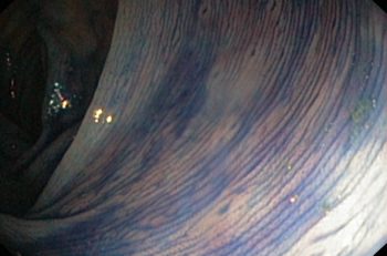 Bildet viser kolon transversum farget med indigo karmin. De små lesjonene en ser er lymfoide follikler.
