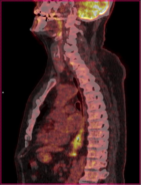 2 FDG PET/CT som viser opptak i lavt differensiert karsinom i øsofagus og regional ­lymfeknutemetastase like inferiort for tumoren (pilhode).