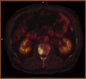 3 a FDG PET/CT viser suspekt opptak til høyre i virvelcorpus