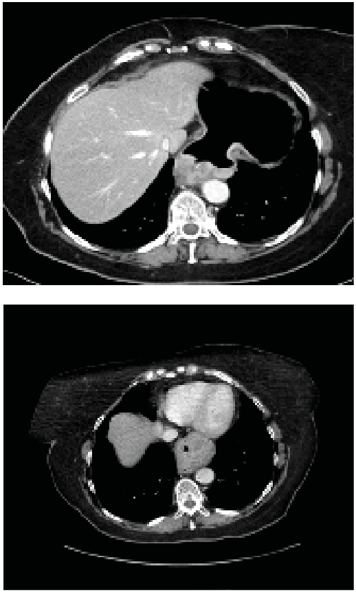 1 c, 1 d Distal øsofaguscancer med nedre begrensing i et hiatushernie. CT gastrografi med CO2-dilatert ventrikkel gir bedre oversikt over tumorutbredelse enn standardprotokoll.