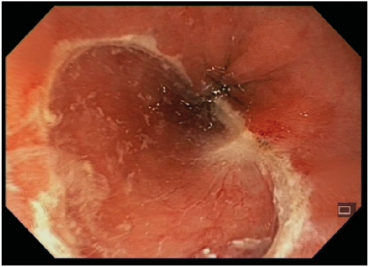 Figur 1. Gummibånd EMR hos pasient med dysplasi i Barretts øsofagus