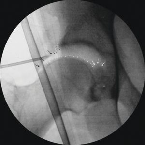 Figur 1. Etter distraksjon av hofteleddet går man først inn med nål under gjennomlysningskontroll.