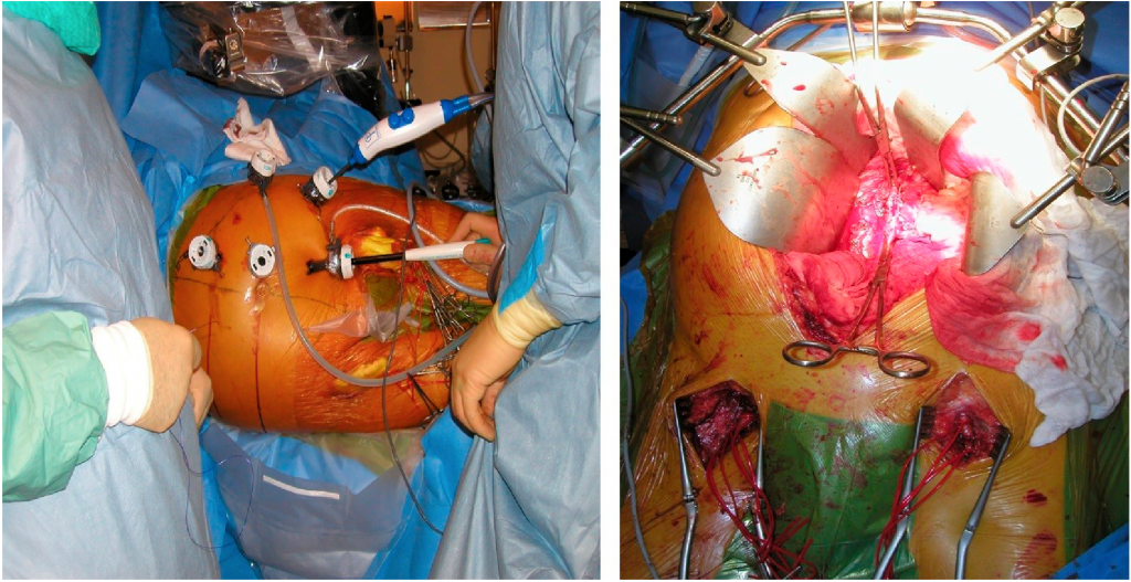 Figur 2: Laparoskopisk (høyre) og åpen (venstre) aortobifemoral bypass