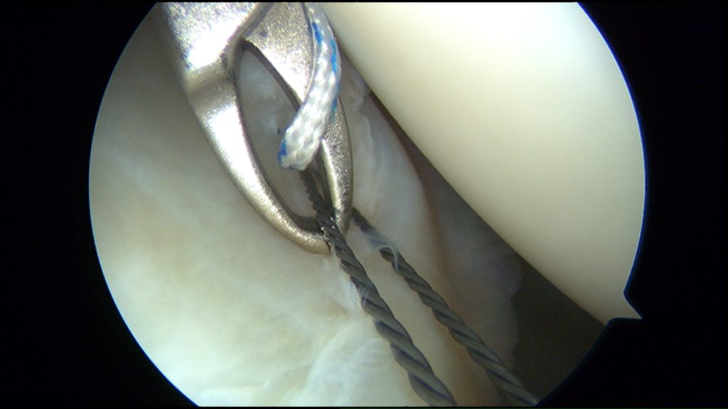 Figur 2. Ved hjelp av sutur lasso og shuttle teknikk føres tråden fra suturankeret, som er boret inn i benet på glenoid, gjennom leddleppen.