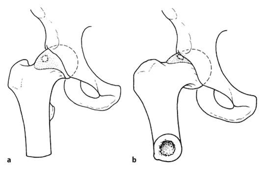 Figur 3. Femuroacetabulær impingement: Avvikende anatomi fører til kollisjon mellom femur og acetabulum.