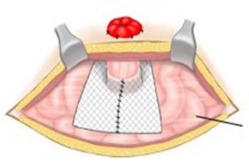 Figur 1: Ekstraperitonealt nett – åpen kirurgi
