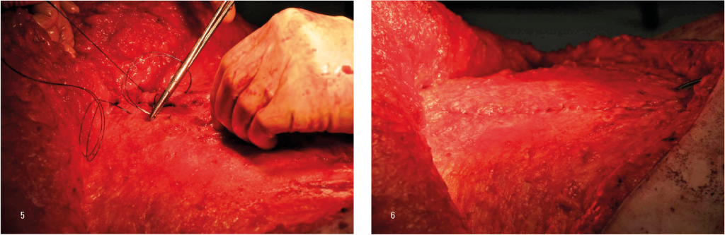 Figur 5: Fortløpende sutur med langsgående tak i fasciekanten Figur 6: Etter lukking i to lag