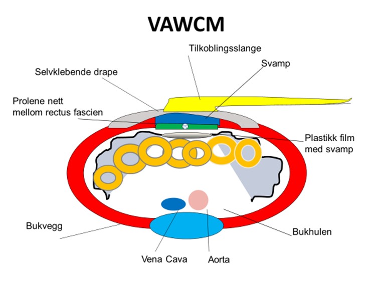 Figur 6b: Skjematisk presentasjon av VAWCM, (Vacuum-assisted wound closure and mesh-mediated fascial traction.