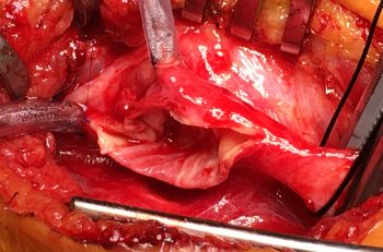 Bilde 1: Arteria carotis med langsgående ­arteriotomi; etter trombendarterektomi.