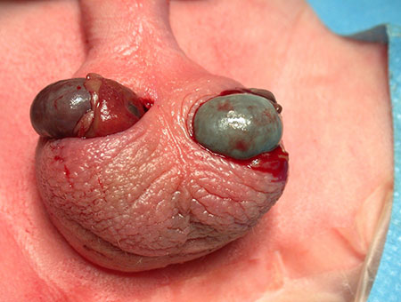 Bilateral ekstravaginal testikkeltorsjon hos nyfødt.