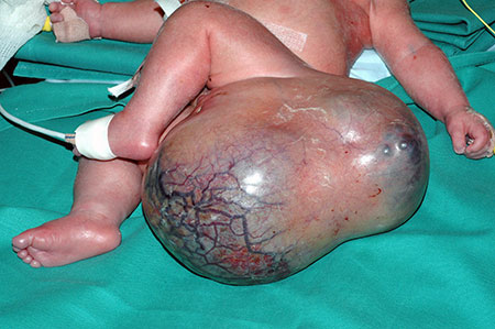 Figur 3. Nyfødt barn med stort sacrococcygealt teratom. 