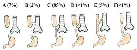 Figur 1. Gross klassifisering av øsofagusatresi, type A-F. Inndelingen er basert på lokalisasjonen av atresien, samt eventuell tilstedeværelse av fistel til trachea. Frekvens av ulike varianter angitt i parentes.