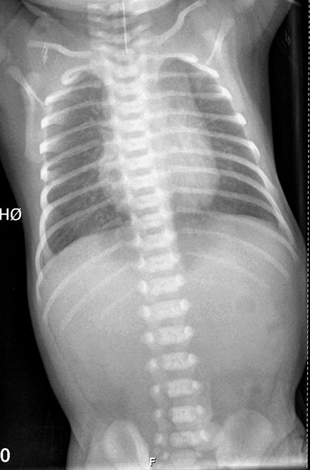 Figur 3. Røntgenbilde viser oroøsofageal sonde i øvre øsofaguslomme. Forøvrig lufttom abdomen, som indikerer øsofagusatresi uten fistel.