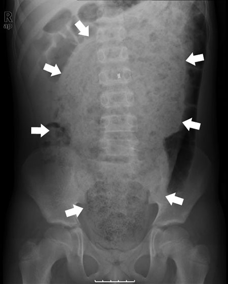 Figur 2. Dette oversiktsbildet hos en 8 år gammel gutt med forstoppelse siden nyfødtperioden viser en dilatert colon sigmoideum fylt med fecalia. (Piler).