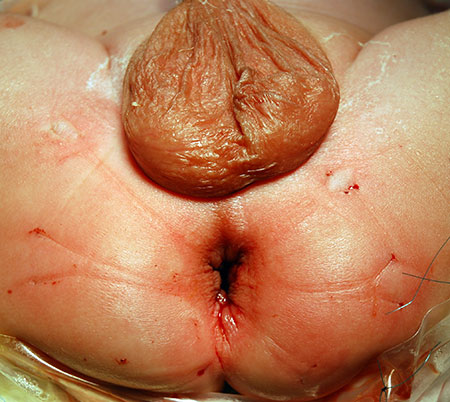 3d) Etter at holdesuturene er fjernet, har hele det anale operasjonssåret trukket seg inn i analkanalen.