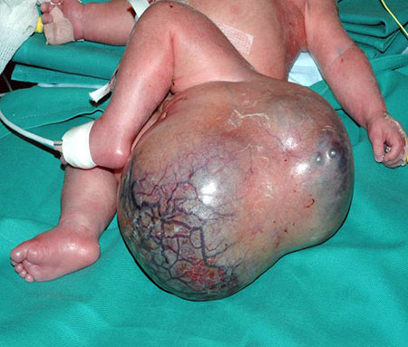 Bilde 1. Sacrococcygealt teratom påvist prenatalt og forløst med keisersnitt ved barnekirurgisk avdeling.