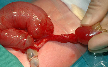 Bilde 3. ”Closing” gastroschise med resulterende kort tarm syndrom. Arteria mesenterica superior er snørt av proksimalt.