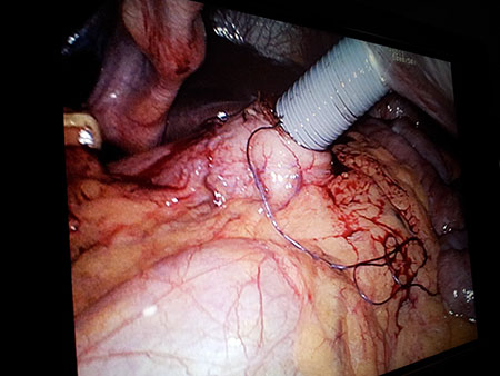 Figur 3. Gastrotomien med sutur. Foto: Monrad-Hansen.