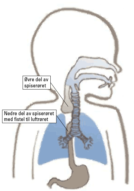 Figur 1. Vanligste form for øsofagus atresi. Illustrasjon: Senter for sjeldne diagnoser, Rikshospitalet.