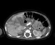 Figur 2: CT-undersøkelse hos 4 måneder gammel pike med leverskade grad 4 som ble ikke-operativt behandlet.