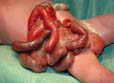 Figur 2: Nyfødt med gastroschise