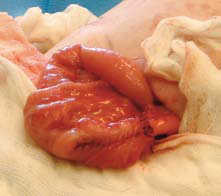 Figur 4. Colon-anastomose med avbrutte suturer. Det sees ”tapering” av proximale colon.