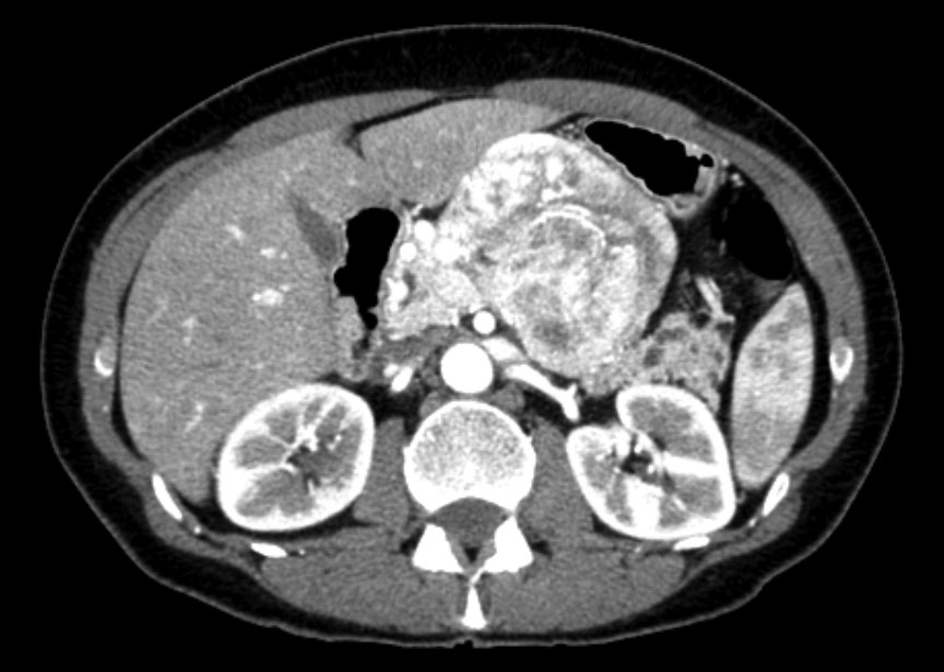 Bilde 1 a) Typisk radiologisk funn ved høyt differensiert endokrin tumor i corpus pancreatis.