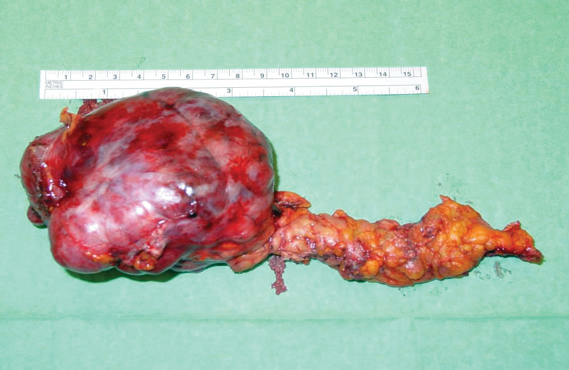 Bilde 1 b) Makropreparat av samme svulst etter laparoskopisk distal pancreasreseksjon
