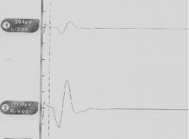 Figur 1. Elektromyografisk summasjons-potensial med tubuselktrode etter stimulasjon med 1 mA av høyre nervus vagus (latenstid ca. 4 ms, amplitude 1118 µV).