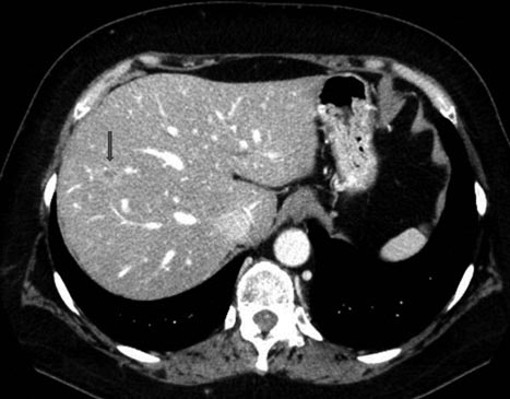 Figur 2: A)CT før RF viser liten metastase (pil) i høyre lapp. Denne metastasen kunne ikke ses på ultralyd, men ble behandlet ved hjelp av bildefusjon. 