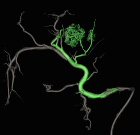 Figur 2: 3D-angiografiopptak gjort under TACE kan bidra til bedre visualisering av tumor og identifisering av tilførende arteriegrener som i denne rekonstruksjonen er markert med grønt.