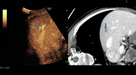 Figur 3: Perkutan RF med bildefusjon. Tumor fremstilt på CT, men ikke på ultralyd. Når GPS-markør (pil) ble plassert på tumor på CT-bildet, ble punktet med samme koordinater vist også på ultralydbildet (pil), slik at den kunne behandles med RF.