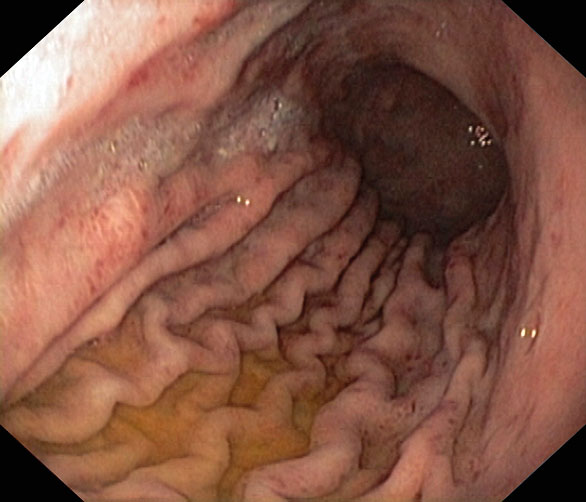 Figur 1. Bilder fra øvre endoskopi ved diagnosetidspunktet hos 15 år gammel pike med nyoppdaget Crohn. Bildene viser aftøse forandringer i distale øsofagus (A), ventrikkel (B) og hemorragiske forandringer prepylort (C).
