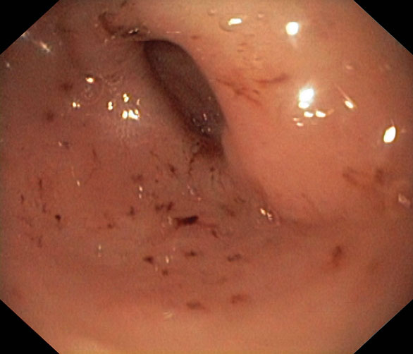 Figur 1. Bilder fra øvre endoskopi ved diagnosetidspunktet hos 15 år gammel pike med nyoppdaget Crohn. Bildene viser aftøse forandringer i distale øsofagus (A), ventrikkel (B) og hemorragiske forandringer prepylort (C).