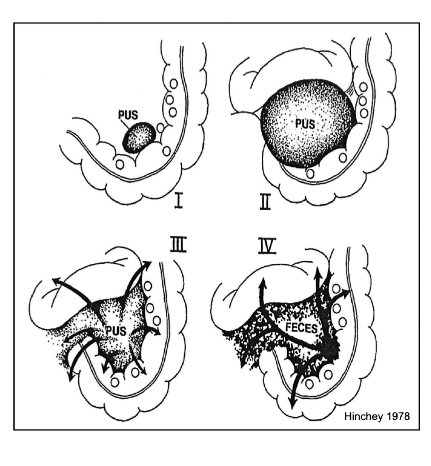 Figur 1. Hinchey klassifikasjon (10): I. Perikolisk abscess; II. Bekkenabscess; III. Purulent peritonitt; og IV. Fekal peritonitt (åpen kommunikasjon mellom tarm og bukhule) 