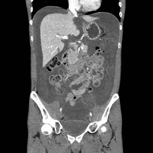 Bilde 7. Preoperativt coronalt CT-bilde hos pasient med pseudomoxama peritonei