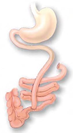 Figur 1. Viser intestinal bypass med 35 cm jejunum og 10 cm ileum