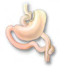 Figur 2. Viser gastric bypass med Roux-en-Y Anastomose.
