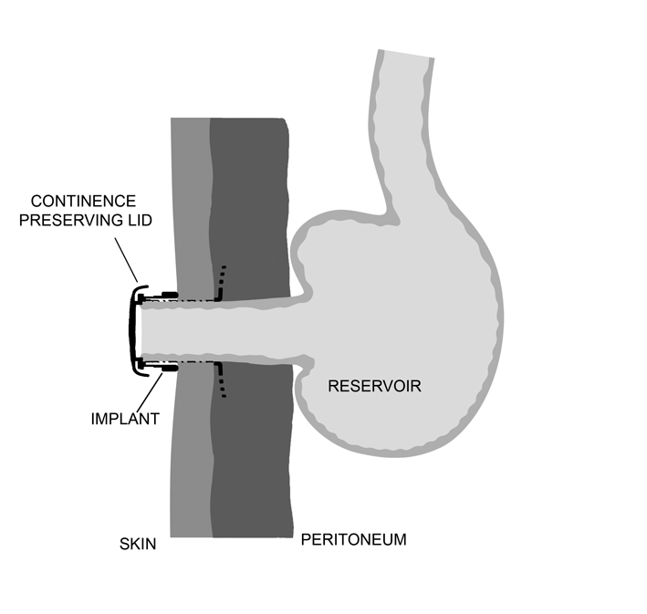 Fig 1. Skjematisk bilde av implantatet i bukveggen koblet til en kontinent ileostomi.