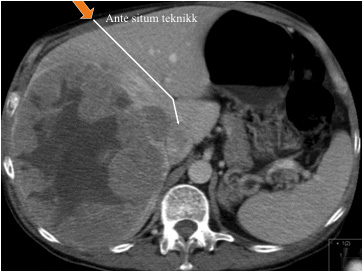 Figur 1. Bildet viser reseksjonslinje ved fremre tilgang (ante situm teknikk). Stort hepatocellulært carcinom med trombe i høyre portvene og antydningsvis i v. cava inf. Pasienten i live 9 år etter reseksjon.