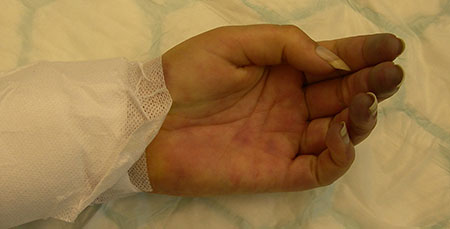 Figur 1. A. Pasient henvist med sirkulasjonsløs hånd etter emboli i venstre overekstremitet. Embolektomi hadde ikke ført frem.