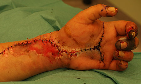 Figur 1. D. En uke senere var sirkulasjonen i hånden fortsatt tilfredsstillende, men med noe mørke fingertupper. Karkirurgene opererte arteria subclavia, som var opphavet til emboliene.